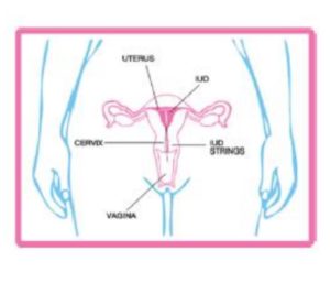 A diagram showing an IUD