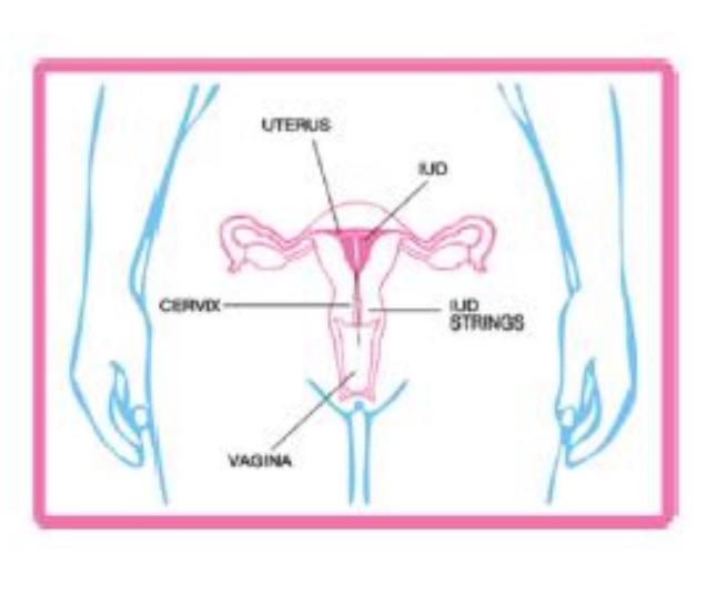 Спираль внутриматочная Kyleena. IUD что это в медицине. Мирена на ладони. Крови после установки спирали мирена