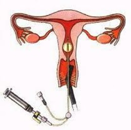 A diagram showing how a thin plastic catheter is passed through the neck of the womb