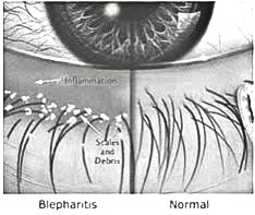 Blepharitis image 1
