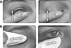 Blepharitis image 2 from patient information