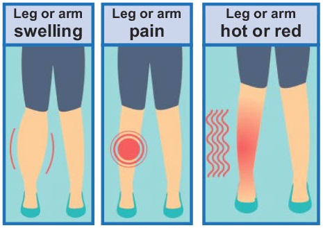 How do you know if you have a blood clot - infographic