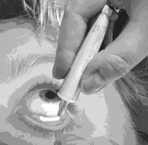 A person applying eye ointment to their eye