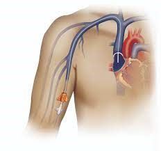 PICC line threaded through the vein