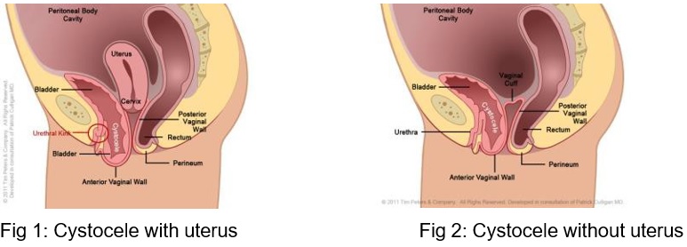 Pelvic floor repair pic 1