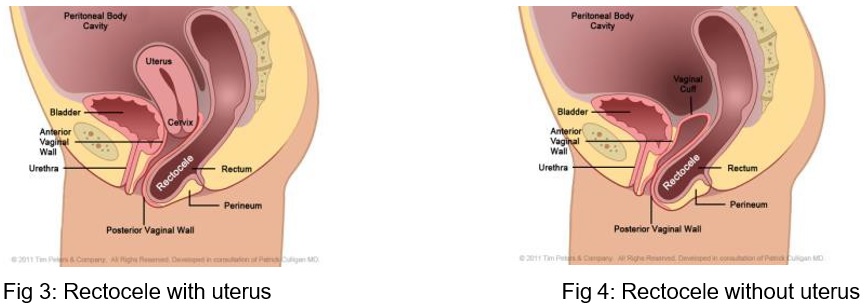 Pelvic floor repair pic 2