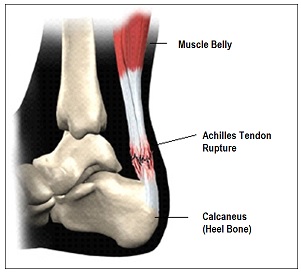 Physio pic 2_achilles awaiting scan