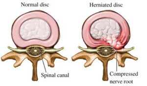 Diagram of a normal and herniated disc