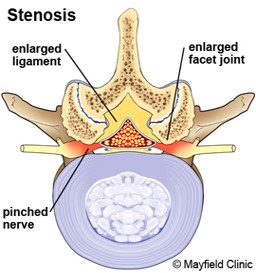 Diagram showing stenosis in the neck