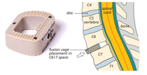 Diagram showing the cage or implant to keep the vertebrae together