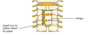 Diagram showing the process for a cervical laminoplasty