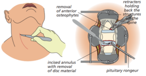 Diagram showing the process involved with ACDF surgery