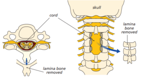 Diagram showing the removal of the lamina bone