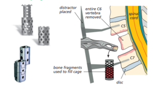 Diagram showing the removal of the vertebrae