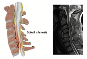 Image of spinal stenosis