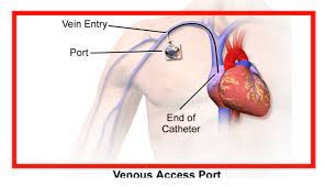 venous access port
