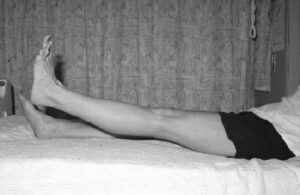 Knee arthroscopy exercises non operated leg in a comfortable position